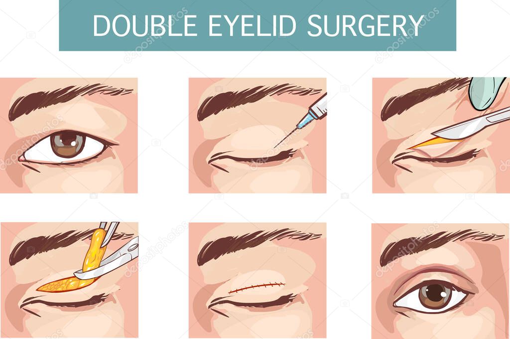 Vector Illustrated set with double eyelid surgery.