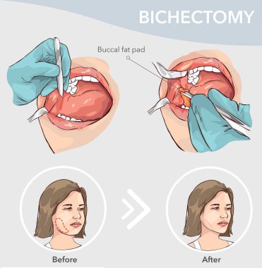 Vektör illüstrasyonundan önce ve sonra Buccal Fat Pad Sökme