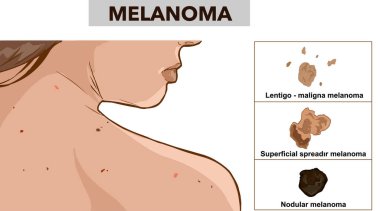 Three types of melanoma vector image