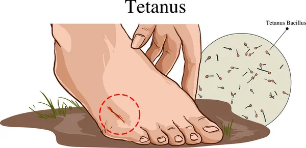 Damage Feet Risk Tetanus — Stock Vector