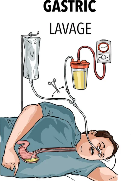 Magenspülung Mit Einer Magensonde — Stockvektor