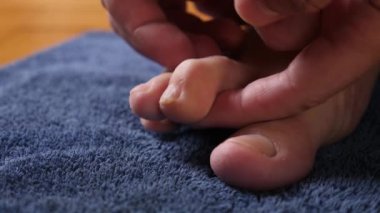 Deformed bent finger in men. Problem with deformity of finger bones.