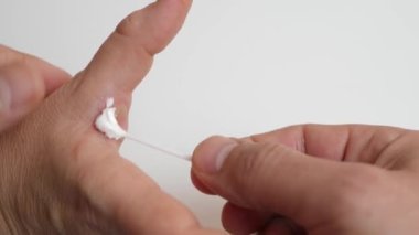Adam, cilt yandıktan sonra kremi eline sürmüş. Cilt yanıkları için ilk yardım.