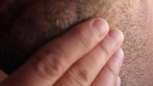 Alopecia Beard Men Cosmetic Defects Body — Vídeo de Stock