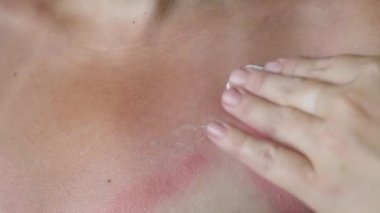 Kadın güneşten etkilenen bölgelere krem sürüyor. Cildinde güneş yanığı. Vücut bakımı. Aşırı güneş yanığı ve cilt tahrişine karşı koruma.