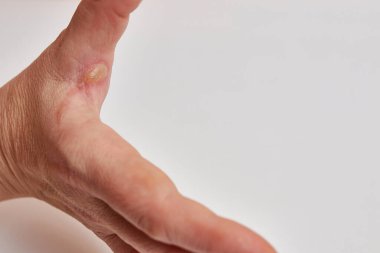 hand with burnt skin  on a white background