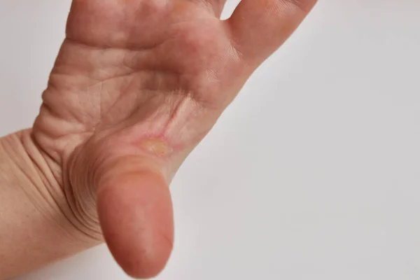 Hand Burnt Skin White Background — Foto Stock