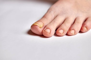 Ayak tırnakları mantar hastalığından etkilenir..