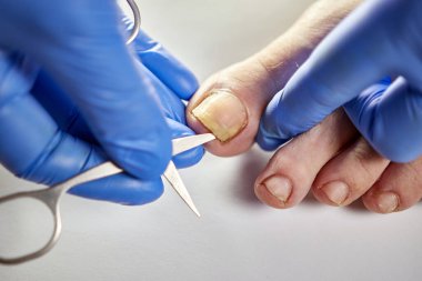 Ayak tırnağı mantardan etkilenir. Tırnak mantarı tedavisi.