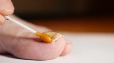 Mantardan etkilenen tırnağa propolis solüsyonu uygula. Çivi mantarı tedavisinde alışılmadık yöntemler.
