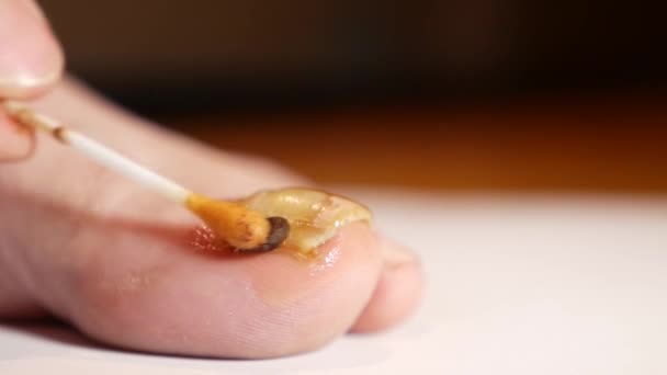 Apply Propolis Solution Nail Affected Fungus Unconventional Methods Nail Fungus — Stok video