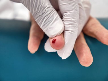 Doktor tıbbi analiz için kan toplamak için parmağını deliyor. Hastalık teşhisi.