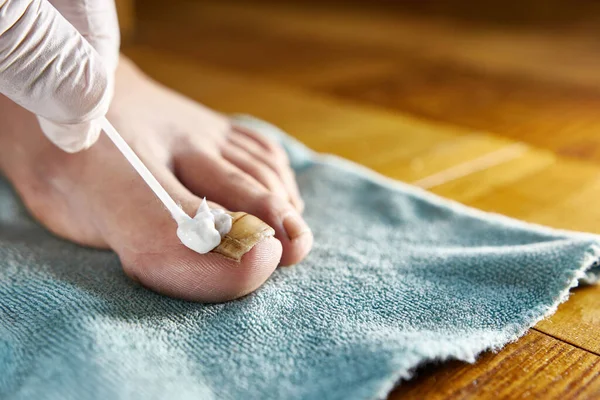 A medicinal cream is applied to the big toe affected by the fungus. Treatment of nail fungus.