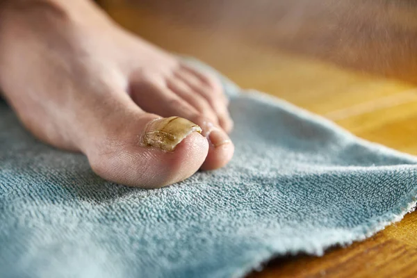 A medicinal solution is applied to the big toe affected by the fungus. Treatment of nail fungus.