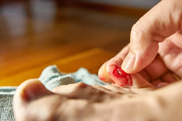 Bloody Bursting Callus Little Toe — Foto Stock