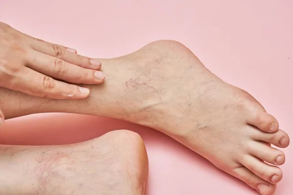 Woman Shows Leg Varicose Veins — Stockfoto