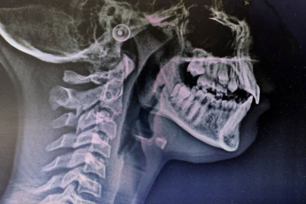 Radiography Denture Client Seen Screen Dental Clinic — Stok fotoğraf