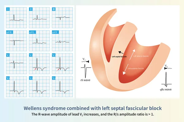 Female Years Old Ecg Collected Onset Chest Pain Wellens Syndrome — Foto de Stock