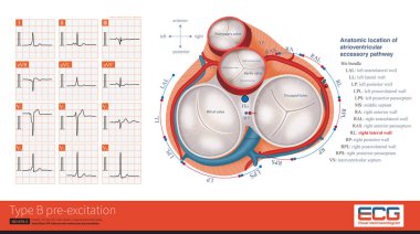 34 yaşında bir kadın, 6 yıldır paroksismal çarpıntı geçmişi var. EKG, B tipi uyarılma olduğunu gösteriyor. Hasta başarılı bir radyasyon temizliği aldı. Aksesuar yolu karavanın daha sonraki yan duvarında bulundu..