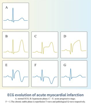 ST segment yüksekliği miyokardiyal enfarktüsünde, ECG 'nin ST-T' si karakteristik bir evrim sürecinden geçecek ve sonunda patolojik Q dalgası gibi görünecek, bazen ömür boyu sürecek..