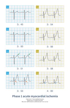 Erkek, 53 yaşında, 3 aydır göğüs ağrısı çekiyor. Holter, yüksek T dalgası ve QRS dalgasının sonundaki bozulmayla karakterize edilen miyokardiyal iskemi yakaladı..