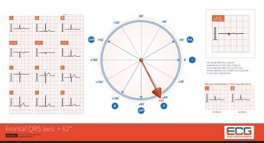 When the frontal QRS axis is at +62, the QRS amplitude of lead  is the highest.The frontal electrical axis is almost perpendicular to aVL lead, so the algebraic sum of QRS wave amplitude in aVL lead is almost zero.