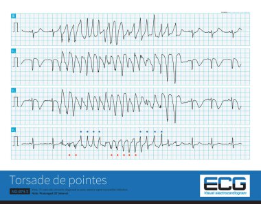 Male, 75 years old, clinically diagnosed as acute anterior septal myocardial infarction.It is best to use 12 leads to diagnose torsade de pointes because some leads may not have torsade characteristic