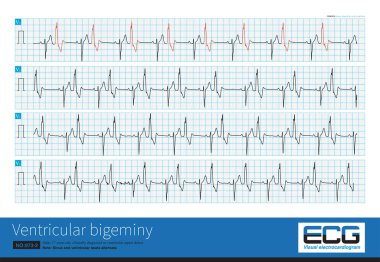 A 17 year old male was clinically diagnosed as ventricular septal defect and his ECG was ventricular bigeminy.Sinus and ventricular beats alternated.This is a long V1 lead.