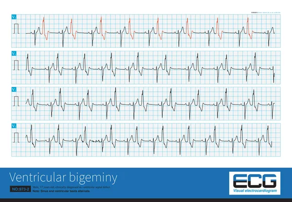 Egy Éves Férfit Klinikailag Kamrai Septalis Rendellenességként Diagnosztizáltak Ekg Kamrai — Stock Fotó