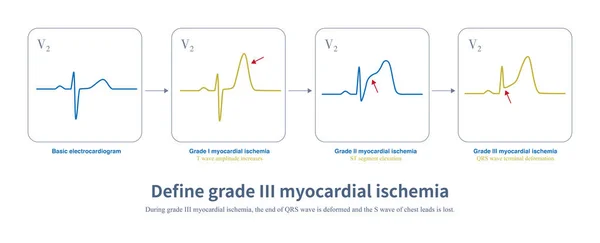 Acute Myocardial Ischemia Amplitude Wave Increased First Segment Elevated End — стоковое фото