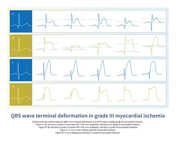 Akut Myocardialis Ischaemia Esetén Qrs Hullám Terminális Deformációja Egy Ekg — Stock Fotó