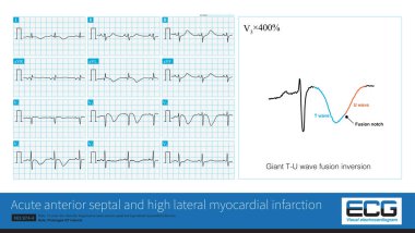 Erkek, 75 yaşında, klinik olarak akut anterior septal ve yüksek yanal miyokardiyal enfarktüs teşhisi konuldu. 12 kurşun EKG, uzayan QT aralığı ile T dalgasının büyük bir tersini gösterdi..