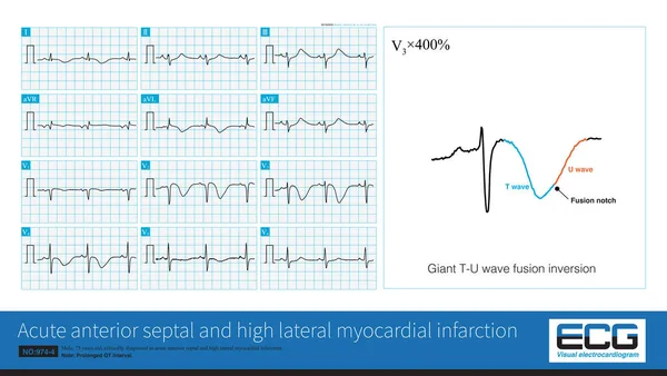 Mand Gammel Klinisk Diagnosticeret Som Akut Anterior Septal Høj Lateral - Stock-foto