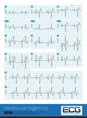 17 yaşındaki bir erkeğe klinik olarak ventriküler septal defekt teşhisi konmuş ve EKG 'si ventriküler bigeminiymiş. Ventriküler prematüre kasılma sol posterior fasiküler bölgede meydana gelmiş..