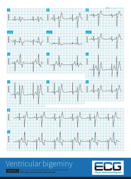 17 yaşındaki bir erkeğe klinik olarak ventriküler septal defekt teşhisi konmuş ve EKG 'si ventriküler bigeminiymiş. Ventriküler prematüre kasılma sol posterior fasiküler bölgede meydana gelmiş..
