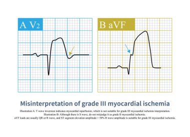 Üçüncü derece miyokardiyal iskemi QRS dalga deformasyonu sadece miyokardiyal iskemi (reperfüzyondan önce) için uygundur ve S dalgasının kaybolması sadece v1-v3 kurşun için uygundur.