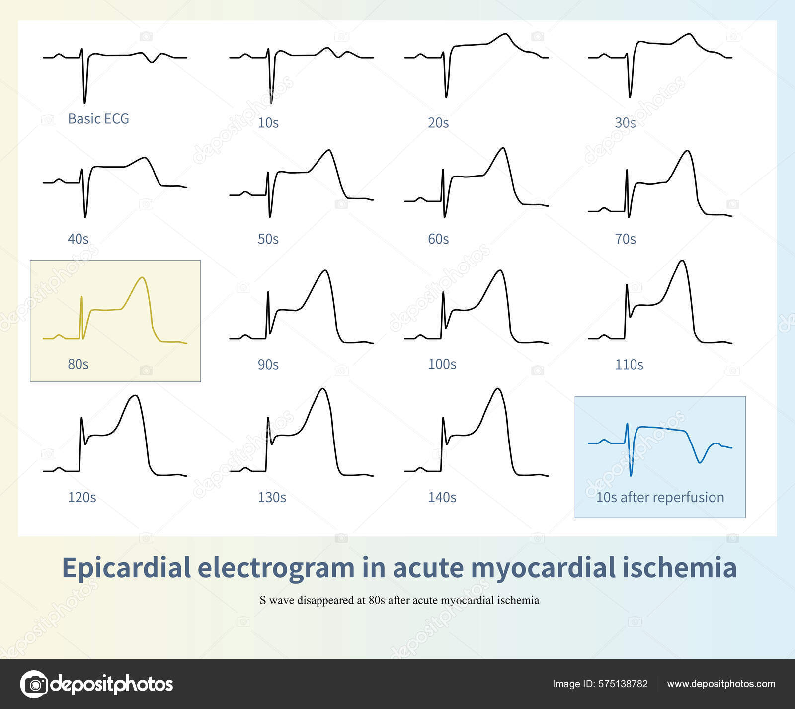Eletrograma Epicárdico Isquemia Miocárdica Aguda Foi Registrado Ligando  Ramo Descendente — Foto © asia11m #575138782, image size:1600x1426