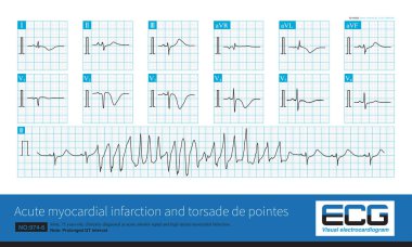 959 Torsade dMale, 75 yaşında, klinik olarak akut anterior septal ve yanal miyokardiyal enfarktüs teşhisi konuldu. Suçlu şahıs LAD proksimal segmentinde bulundu. TDPe noktalarıyla uzatılmış QT aralığı.