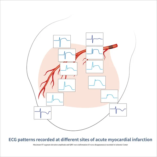 In acute myocardial infarction, the ECG patterns are different from the ischemic center to the ischemic edge. The closer to the center, the greater the QRS-ST-T changes.