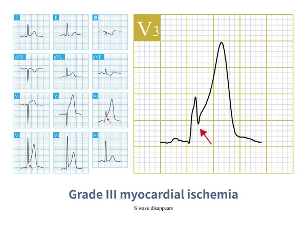 Male, 58 years old, admitted with chest pain for 30 minutes. ECG showed hyperacute T wave, acute myocardial ischemia involving high lateral wall and anterior wall. The disappearance of S wave in leads V3 and V4 was grade III myocardial ischemia.