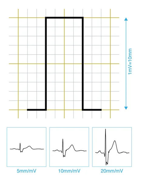 Feszültséget Különböző Ekg Kalibrációs Feszültségre Vezetik Ekg Elhajlás Amplitúdója Más — Stock Fotó