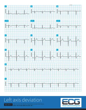 Erkek, 50 yaşında, koroner kalp rahatsızlığı var. Ön QRS ekseni sol ön fasiküler bloğu teşhis etmek için yeterli olmayan -39 'du. Öncü II QRS ana dalgası negatif..