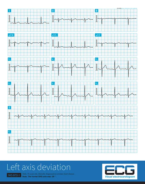 Male, 50 years old, suffering from coronary heart disease. The frontal QRS axis was -39 , which was not enough to diagnose left anterior fascicular block.Lead II QRS main wave is negative.