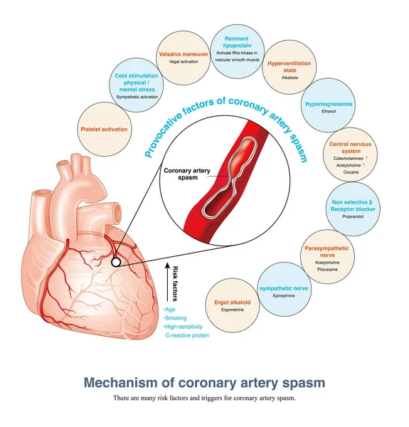 1Smoking is the most dangerous factor for coronary artery spasm. Body inflammatory factors can also stimulate coronary artery spasm.Autonomic nerve tension can also trigger coronary spasm.