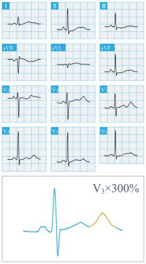 54 yaşında bir kadın, 2 yıl boyunca tekrar eden bir senkop geçirmiş. Klinik tanı, tip 2 uzun QT sendromuydu. Kanındaki potasyum normal, U dalgası olarak T dalgasına yanlış tanı koyma..