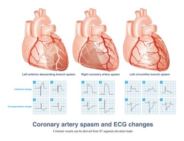 Coronary artery spasm causes transmural myocardial ischemia, and ST segment elevation in ECG has localization characteristics. Criminal vessels can be derived from ST segment elevation leads in ECG. clipart