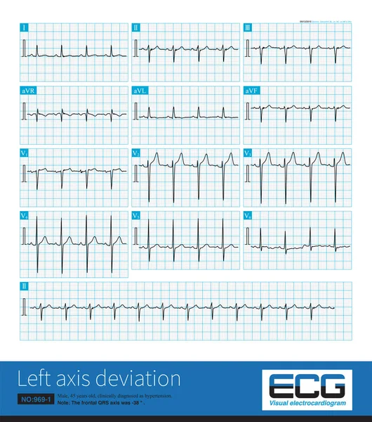 Male Years Old Suffering Hypertension Frontal Qrs Axis Which Enough — Stockfoto