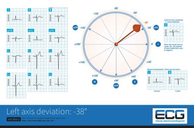 Erkek, 45 yaşında, yüksek tansiyondan muzdarip. Ön QRS ekseni -38 idi ve sol ön fasiküler bloğu teşhis etmek için yeterli değildi. Öncü II QRS ana dalgası negatif.