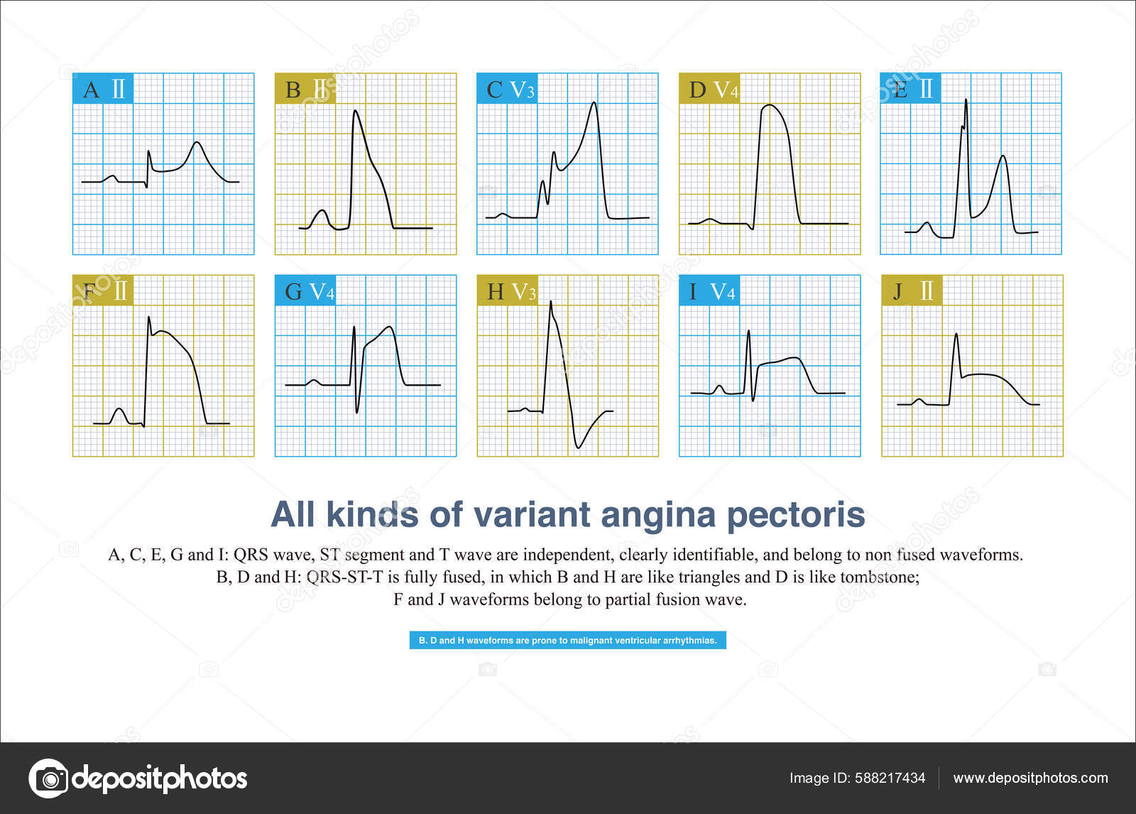 Durante Inicio Variante Angina Pecho Ecg Divide Onda Fusión Onda