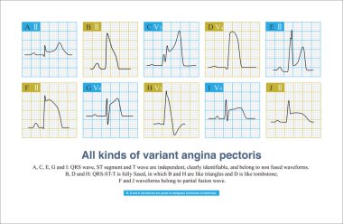 During the onset of variant angina pectoris, ECG is divided into non fusion wave, partial fusion wave and complete fusion wave according to the fusion degree of QRS wave, ST segment and T wave. clipart
